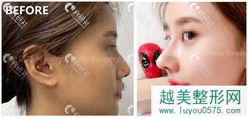 韩国珠儿丽整形外科驼峰鼻矫正案例对比图