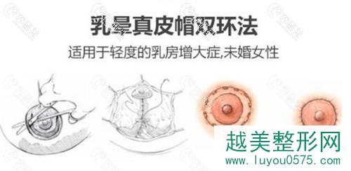 上海时光乳晕货源优质帽双环法示意图