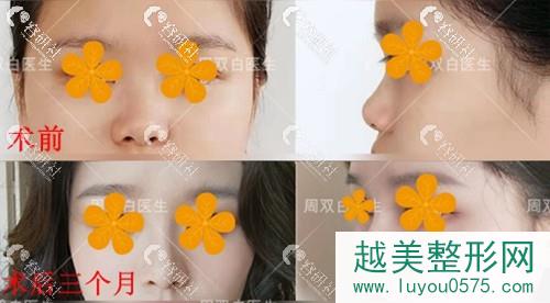 上海九院周双白隆鼻术前术后对比