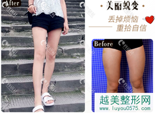武汉艺星大腿吸脂案例对比图