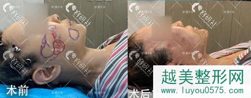 北京联合丽格第二医疗美容医院王志军面部抗衰除皱案例
