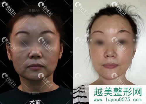 北京联合丽格第二医疗美容医院面部抗衰提升案例