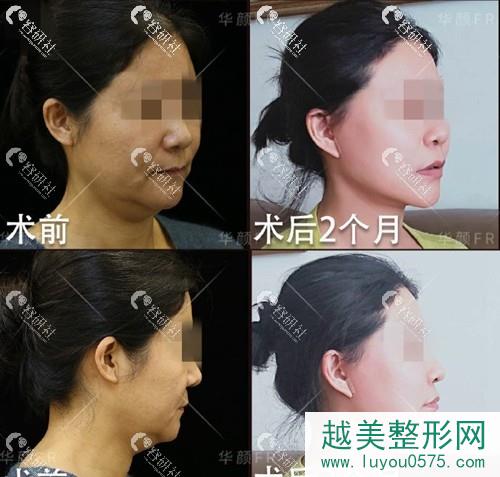北京联合丽格第二医疗美容医院面部抗衰除皱术前术后对比