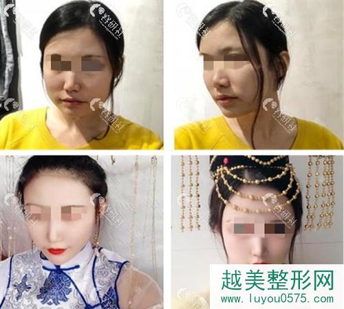 杭州时光医疗美容医院下颌角整形案例