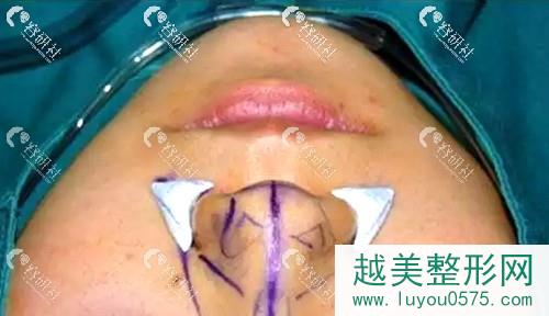 鼻基底凹陷填充位置示意图