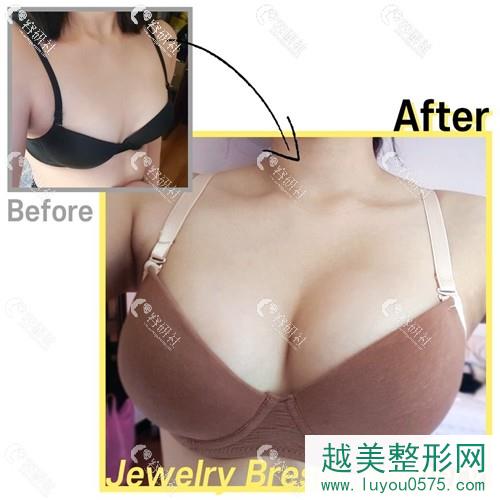 韩国珠儿丽蓓拉假体隆胸案例对比图