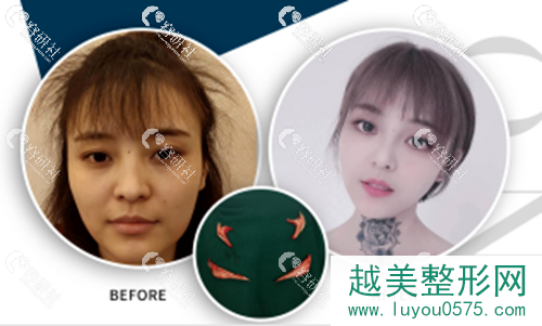 上海仁爱医院刘先超下颌角截骨案例对比图