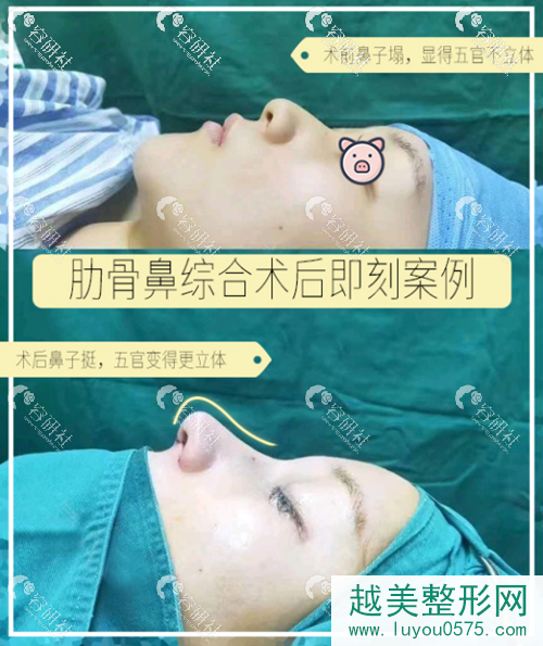 南京鼻祖肋软骨鼻部手术案例