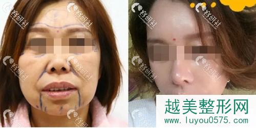 北京华韩医疗美容医院拉皮手术案例
