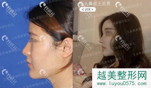 上海喜美医疗美容门诊部隆鼻案例