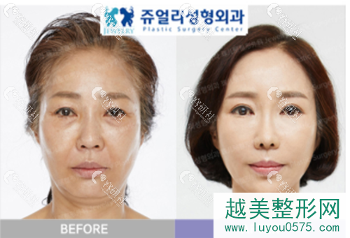韩国珠儿丽拉皮手术案例