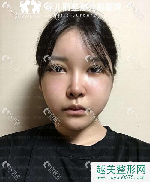 韩国珠儿丽眼鼻手术术后