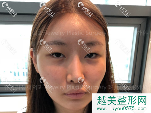 在韩国珠儿丽医院做面部轮廓手术前