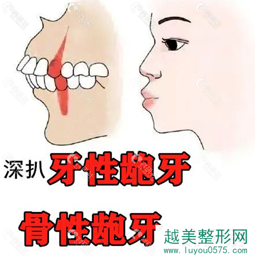骨性龅牙和牙性龅牙区别图