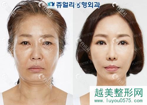 韩国珠儿丽整形外科医院拉皮手术案例