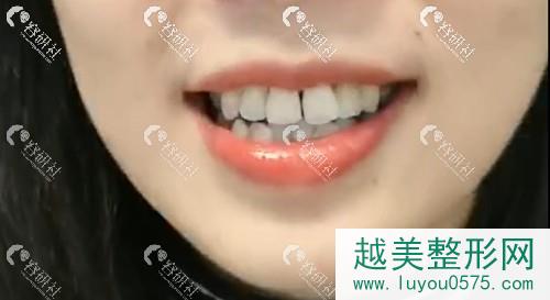 上海哪位医生可以做舌侧矫正？