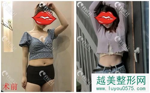 南京艺星医疗美容腰腹吸脂案例