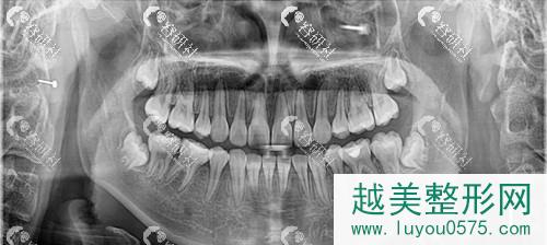 北京牙管家牙齿矫正术后果