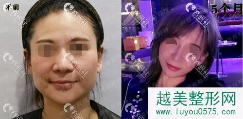 上海时光下颌角手术案例