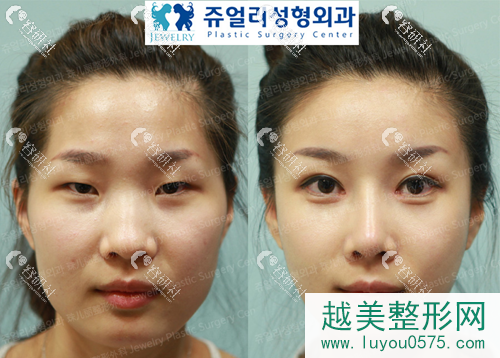 韩国珠儿丽医院做网红眼部手术案例
