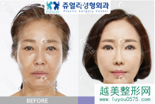 韩国珠儿丽医院拉皮手术案例