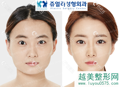 韩国珠儿丽医院下颌角整形案例