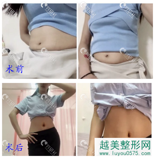 南京康美整形医院吸脂瘦腰腹案例