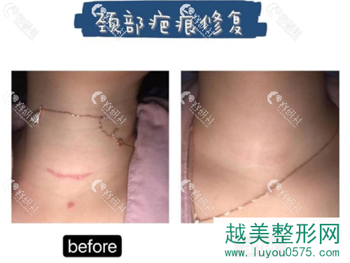 上海清沁医疗美容门诊部疤痕修复案例