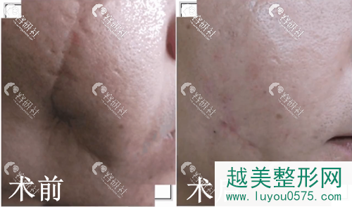 上海江城医疗美容医院疤痕修复案例