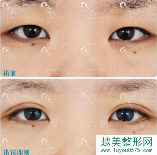 北京领医双眼皮手术案例
