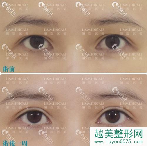 北京领医双眼皮术前术后对比照