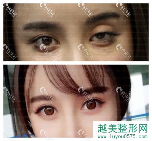 韩国朱文丽医院八次双眼皮修复后案例对比