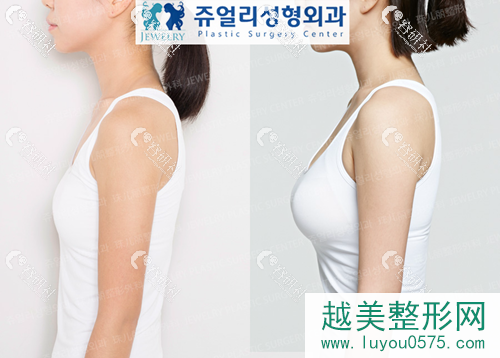 韩国珠儿丽整形外科医院隆胸案例