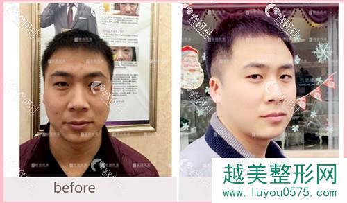 广州健丽医美男士去眼袋术前术后7天对比照