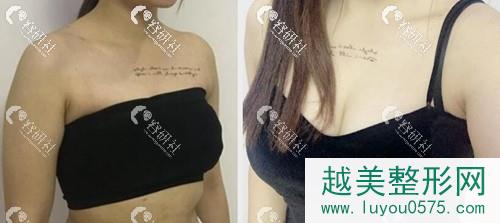 北京八大处栾杰隆胸手术案例