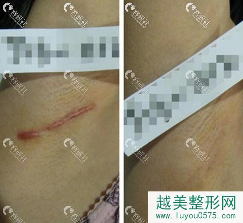 上海清沁医疗美容门诊部董雷疤痕修复案例
