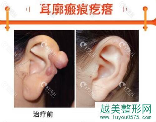 上海清沁董雷耳廓瘢痕疙瘩修复真人案例
