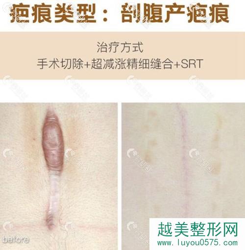 上海清沁董雷剖腹产疤痕修复案例