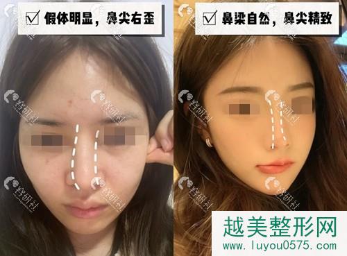 重庆军美医疗美容医院鼻修复案例
