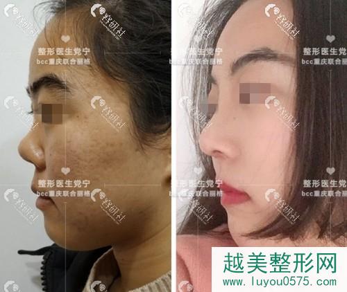 重庆联合丽格美容医院鼻修复案例