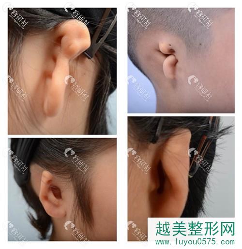 先天性耳畸形分类
