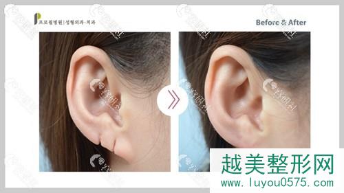 耳廓缺损修复后果