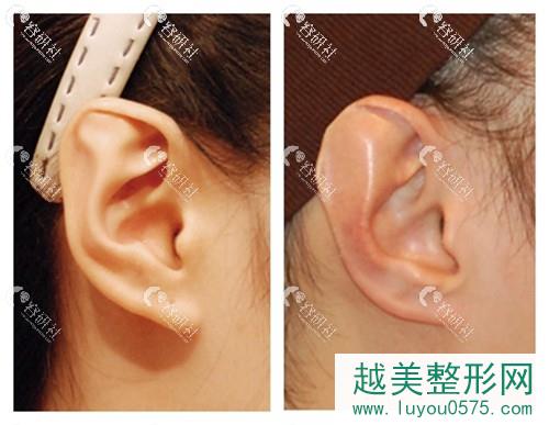 耳廓外凸可以通过手术矫正吗