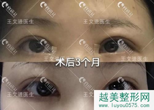 上海九院王文进割双眼皮手术案例