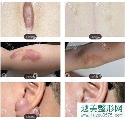 上海清沁医疗美容门诊部祛疤前后果对比