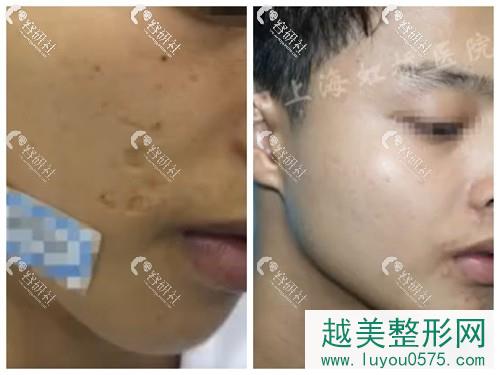 上海虹桥医院疤痕修复中心凹陷性疤痕改善果