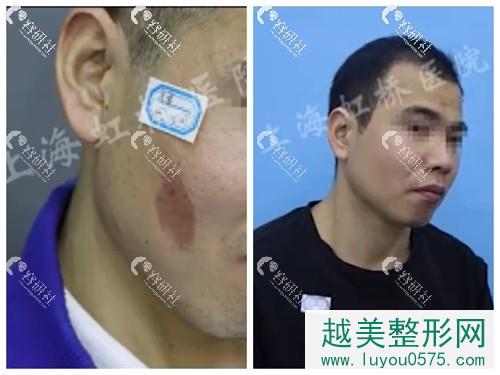 上海虹桥医院疤痕修复中心色素疤痕改善果