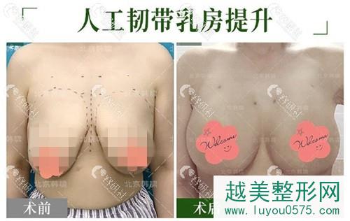 北京韩啸人工韧带乳房提升案例