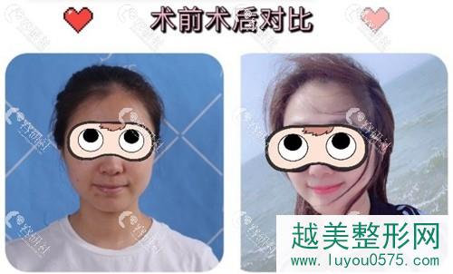 北京美莱医疗美容医院超激光美肤祛斑案例
