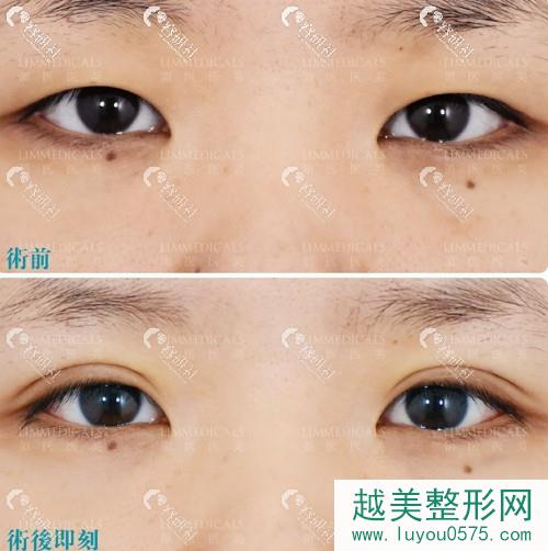 北京领医日式双眼皮案例